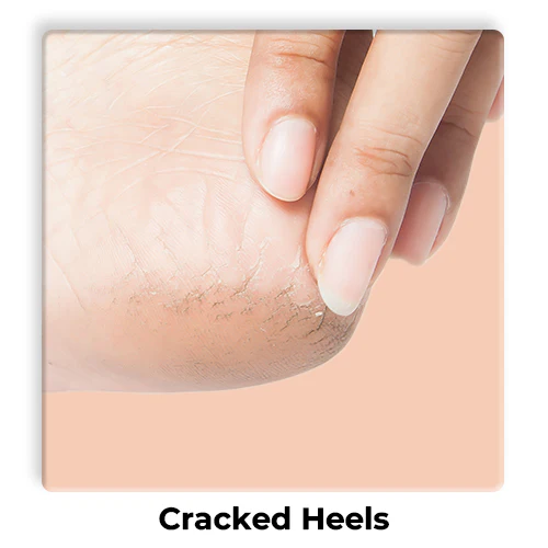 Cracked-Heels-1_28fb6c6c-e3ed-4ae8-bf15-122772af9d54
