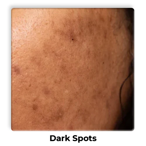 Dark-Spots-1