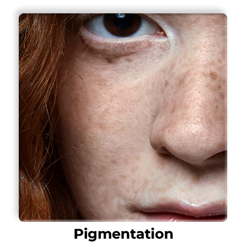 Pigmentation-1