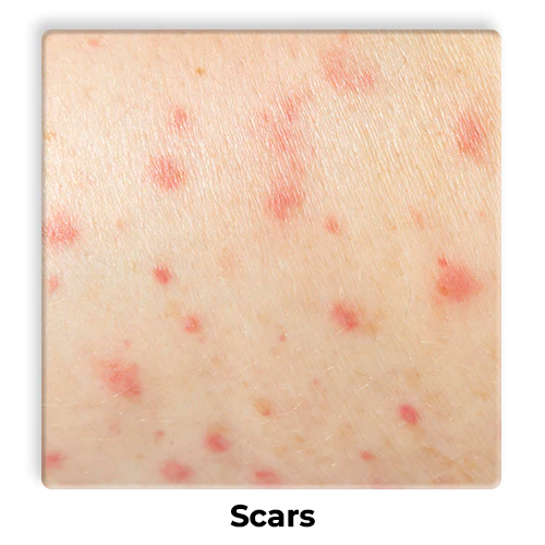 Scars-1