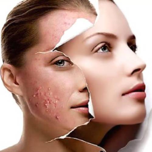Acne Treatment